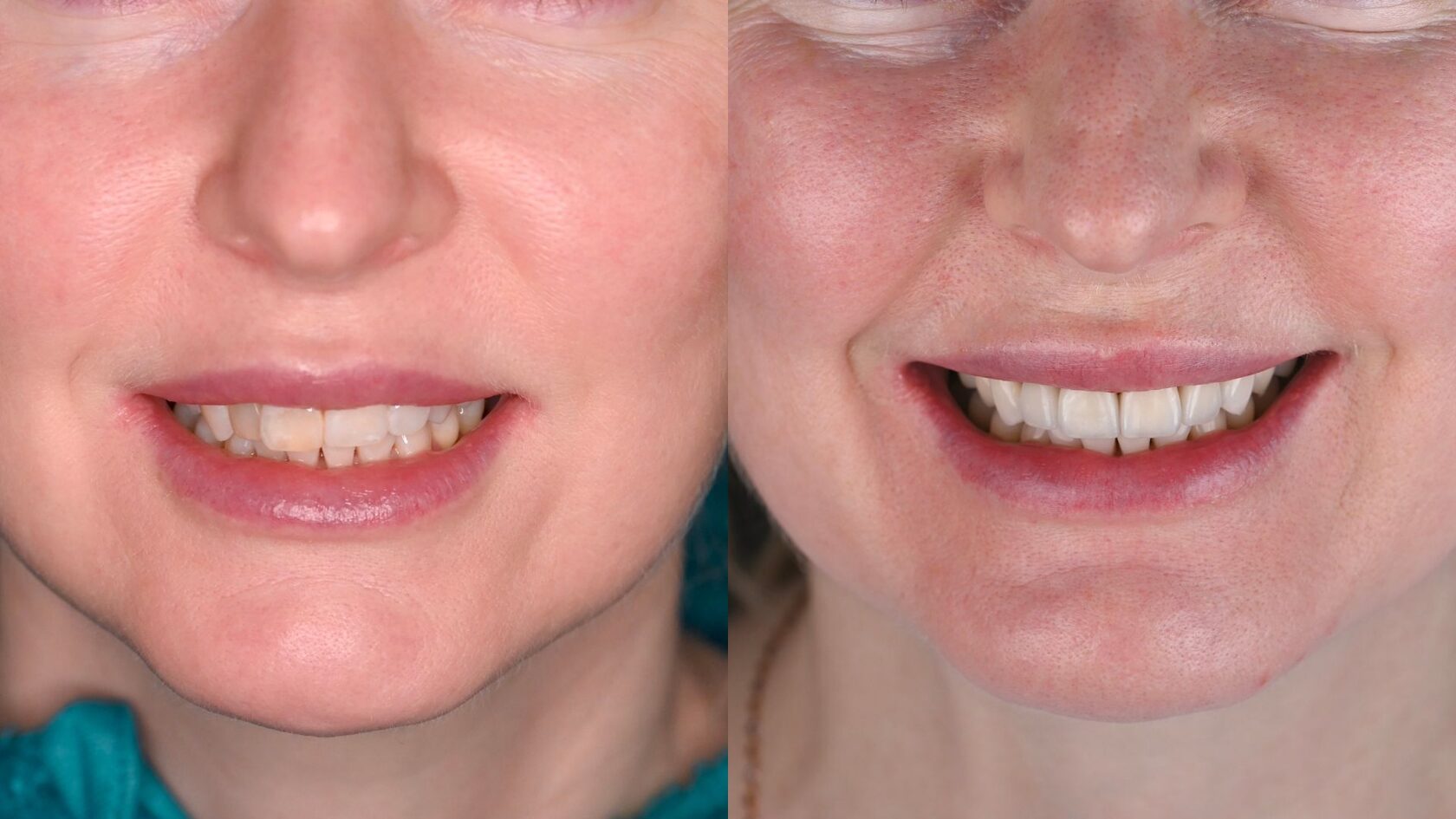 Before and after — 6-tooth veneer smile refinement at LAVA Dental Studio