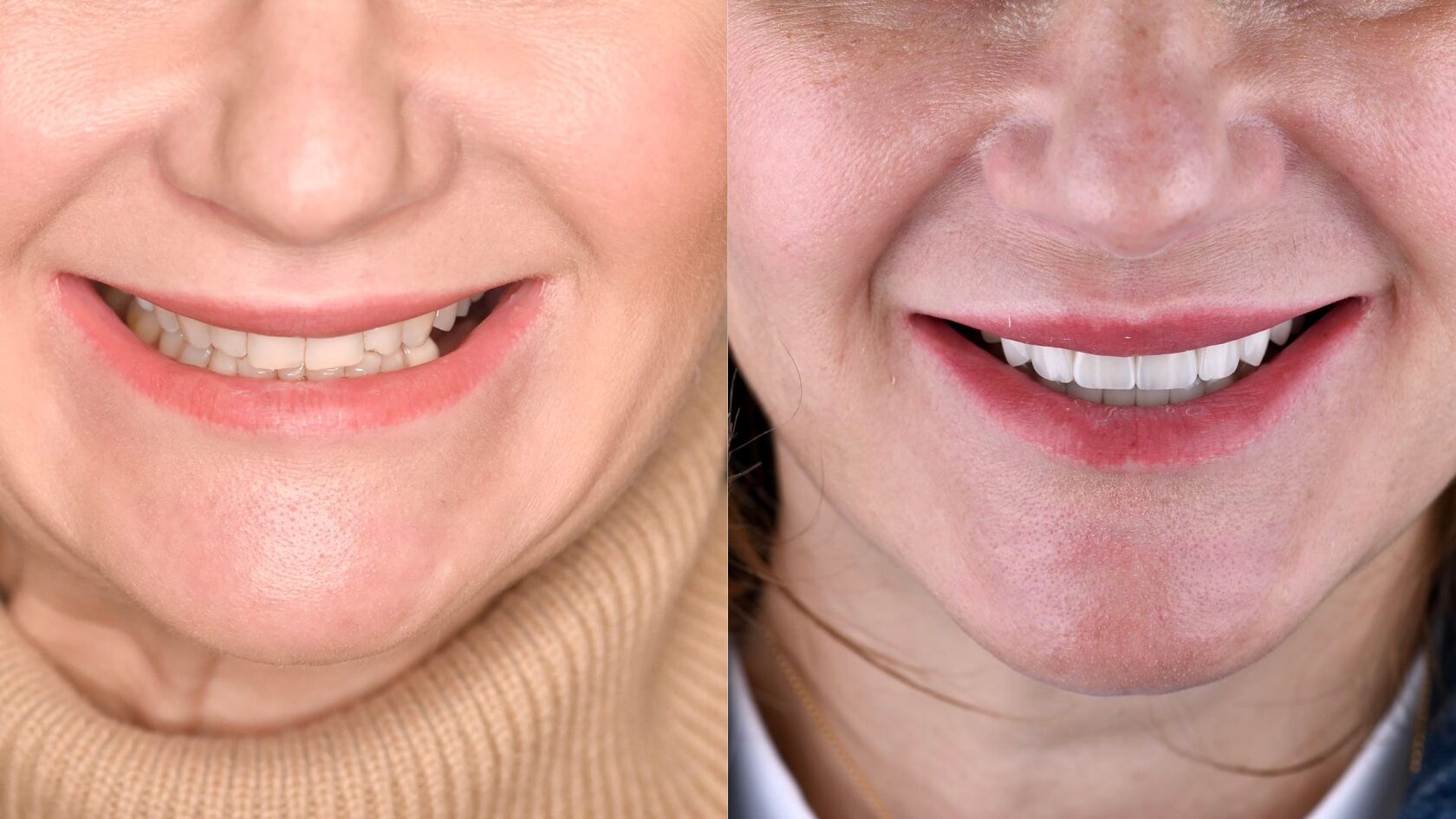 Before and after — full smile restoration at LAVA Dental Studio