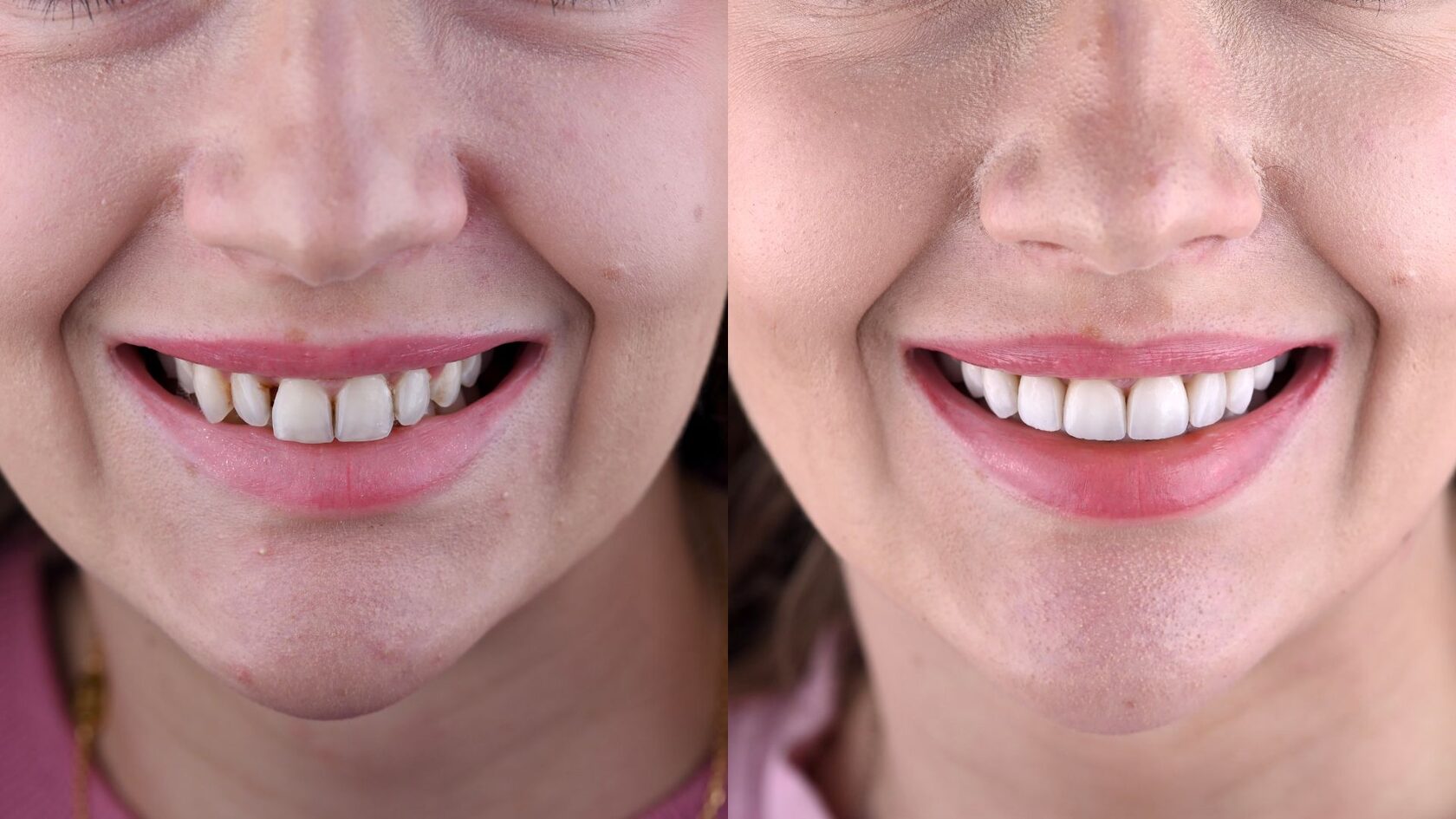 Before and after — smile aesthetic refinement post-braces at LAVA Dental Studio